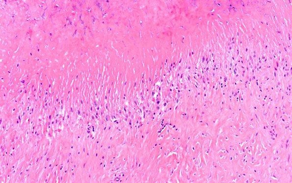 2A5 Rheumatoid nodule, skin (Case 2) H&E 6