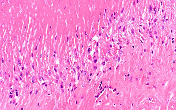 2A6 Rheumatoid nodule, skin (Case 2) H&E 7