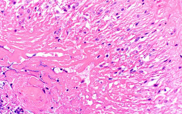 2A7 Rheumatoid nodule, skin (Case 2) H&E 5