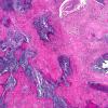 3A1 Rheumatoid nodule (AANP 1978, Case 10) H&E X2 1