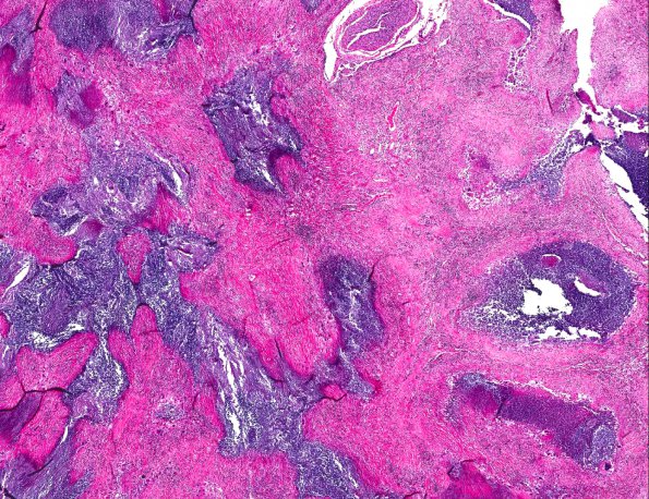 3A1 Rheumatoid nodule (AANP 1978, Case 10) H&E X2 1