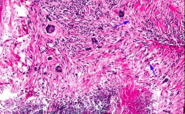 3A3 Rheumatoid nodule (AANP 1978, Case 10) 1 copy