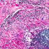 3A4 Rheumatoid nodule (AANP 1978, Case 10) H&E X20 2 copy