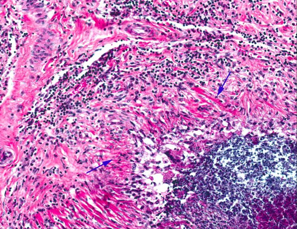 3A4 Rheumatoid nodule (AANP 1978, Case 10) H&E X20 2 copy