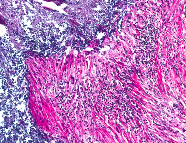 3A5 Rheumatoid nodule (AANP 1978, Case 10) H&E X20 3