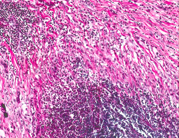 3A6 Rheumatoid nodule (AANP 1978, Case 10) H&E X20 4