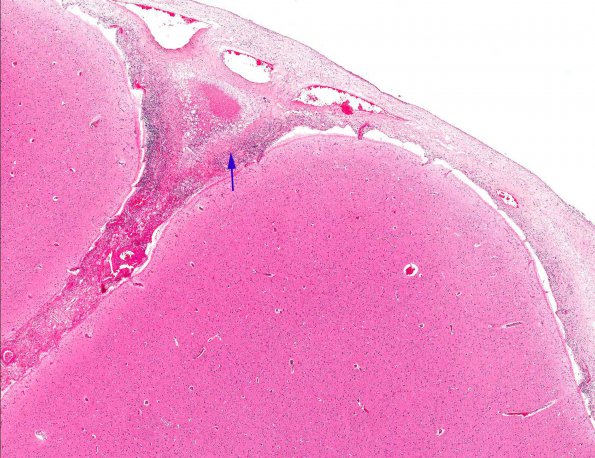 4A1 Rheumatoid Meningitis (AANP 2001 Case 6) H&E X2 1 copy