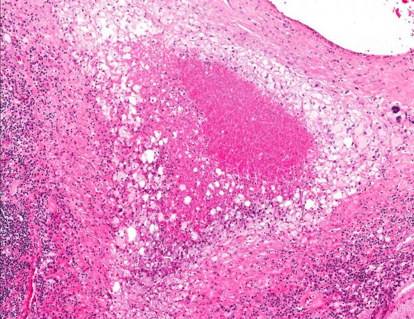 4A2 Rheumatoid Meningitis (AANP 2001 Case 6) H&E X10 1