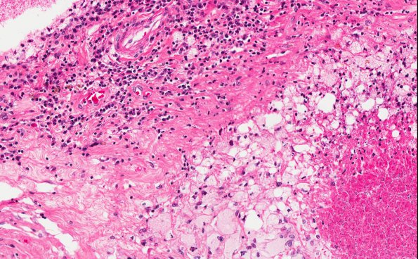 4A3 Rheumatoid Meningitis (AANP 2001 Case 6) H&E 2