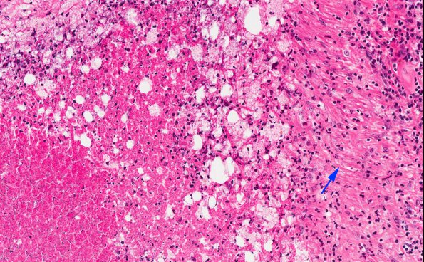 4A5 Rheumatoid Meningitis (AANP 2001 Case 6) H&E 3 copy