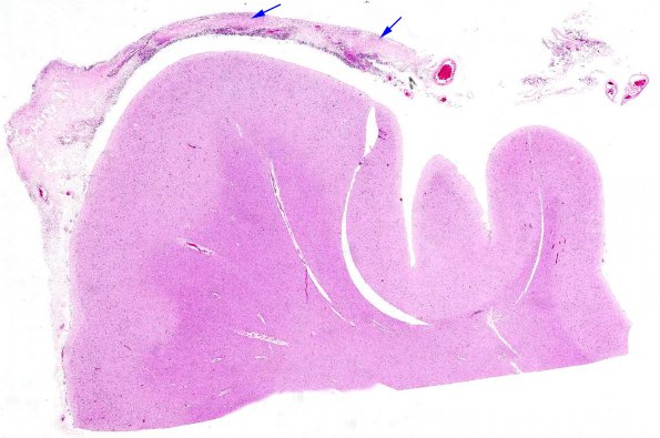 5A1 Rheumatoid Dz, systemic (AANP 1988, Case 6) H&E whole mount copy 2