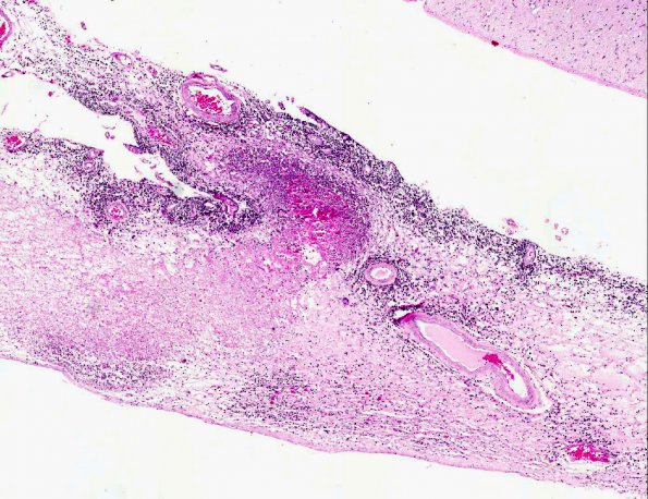 5A2 Rheumatoid Dz, systemic (AANP 1988, Case 6) H&E X4 1