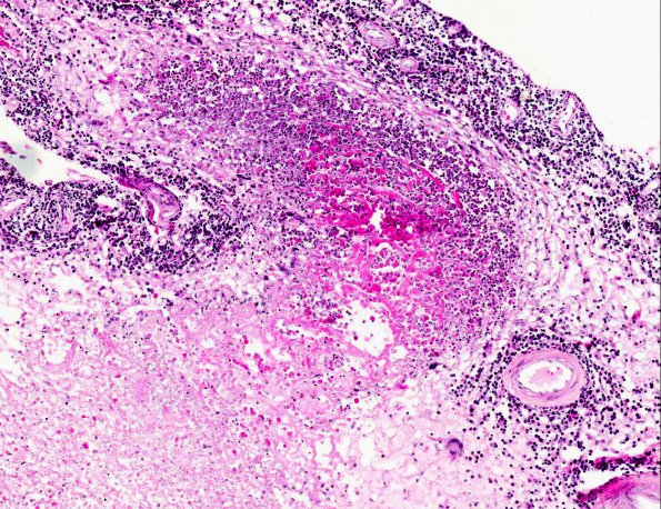 5A3 Rheumatoid Dz, systemic (AANP 1988, Case 6) H&E X10 1