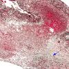 5B1 Rheumatoid Dz, systemic (AANP 1988, Case 6) H&E Trichrome 2 copy