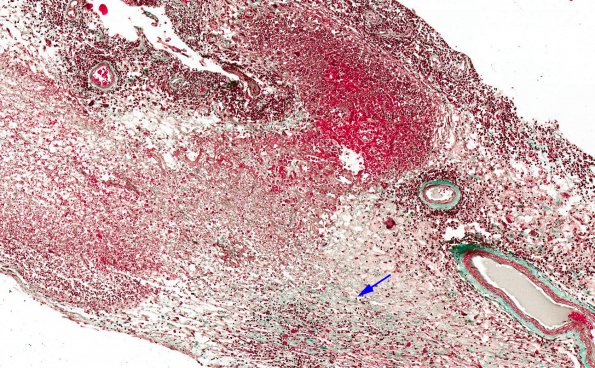 5B1 Rheumatoid Dz, systemic (AANP 1988, Case 6) H&E Trichrome 2 copy