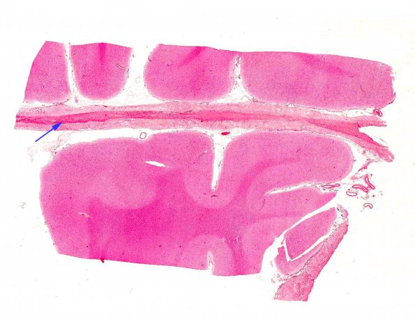 6A1 Rheumatoid pachymeningitis (AANP 1981, Case 5) H&E X0