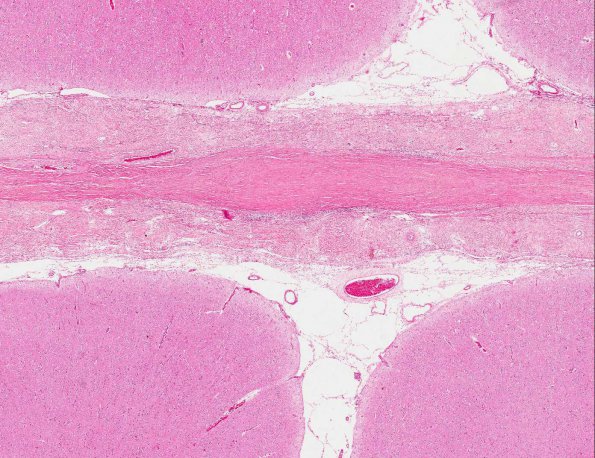 6A2 Rheumatoid pachymeningitis (AANP 1981, Case 5) H&E X2 2