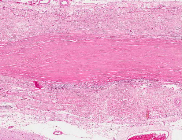 6A3 Rheumatoid pachymeningitis (AANP 1981, Case 5) H&E X5 2