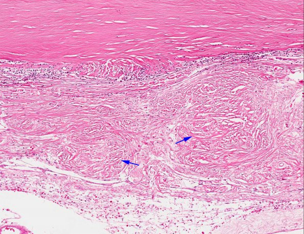 6A4 Rheumatoid pachymeningitis (AANP 1981, Case 5) H&E X10 2 copy