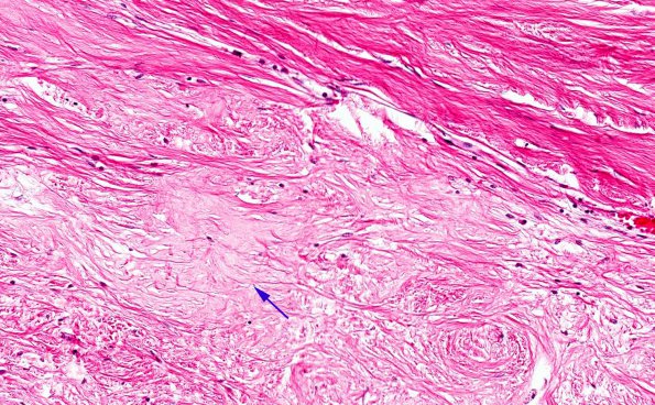 6A5 Rheumatoid pachymeningitis (AANP 1981, Case 5) H&E 13 copy