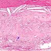 6A6 Rheumatoid pachymeningitis (AANP 1981, Case 5) H&E 6 copy