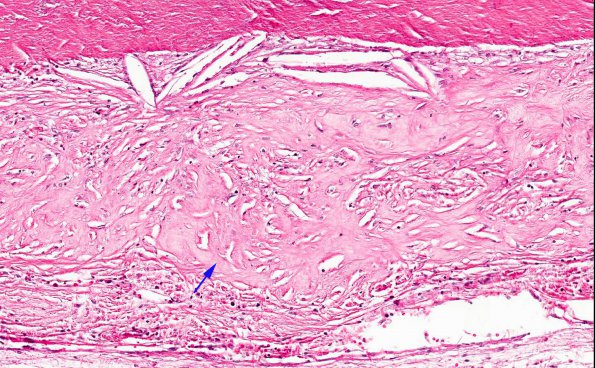 6A6 Rheumatoid pachymeningitis (AANP 1981, Case 5) H&E 6 copy