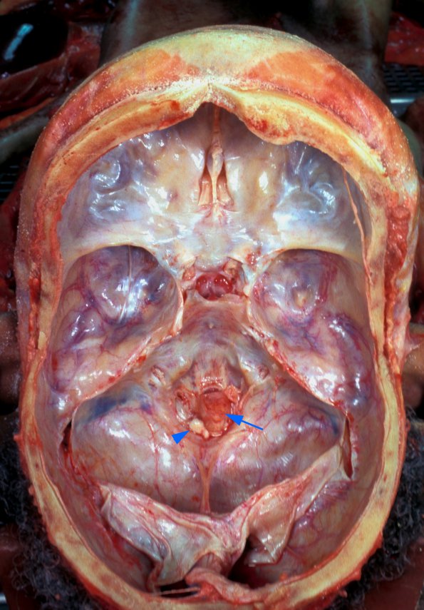 7A1 Odontoid Subluxation (Rheumatoid A) (Case 3) 1 Compress Medulla copy