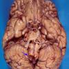 7A2 Odontoid Subluxation (Rheumatoid A) (Case 3) 2 Compress Medulla copy