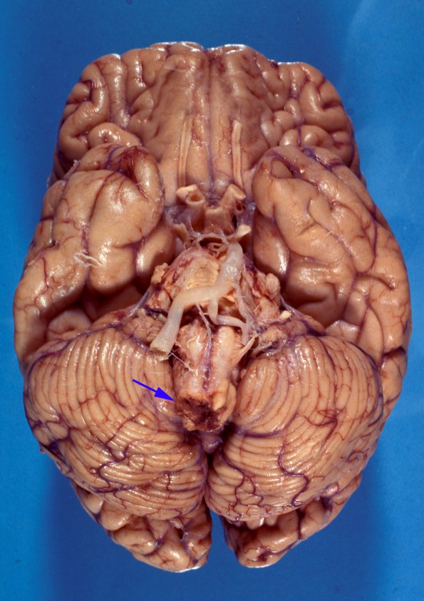 7A2 Odontoid Subluxation (Rheumatoid A) (Case 3) 2 Compress Medulla copy