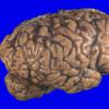 1A1 Wolfram syndrome (Case 1) _2