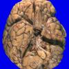 1A2 Wolfram syndrome (Case 1) _1