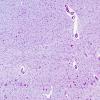 1C3-Wolfram-syndrome-Case-1-HC-N10-LGN-LFB-PAS-2.jpg