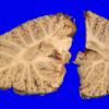 1F2 Wolfram syndrome (Case 1) _16