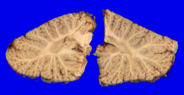 1F2 Wolfram syndrome (Case 1) _16
