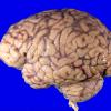 2A1 Wolfram Syndrome (Case 2) _2