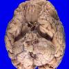 2A2 Wolfram Syndrome (Case 2) _1