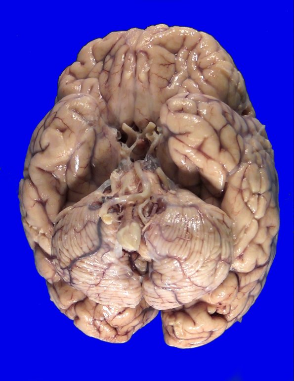 2A2 Wolfram Syndrome (Case 2) _1
