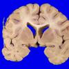 2A3 Wolfram Syndrome (Case 2) _8