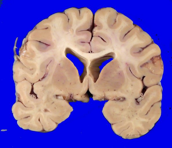 2A3 Wolfram Syndrome (Case 2) _8