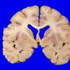 2A4 Wolfram Syndrome (Case 2) _9