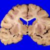 2A5 Wolfram Syndrome (Case 2) _10
