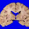 2A6 Wolfram Syndrome (Case 2) _11