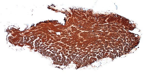 2D10 IWolfram syndrome (Case 2) N15 GFAP 4X 1
