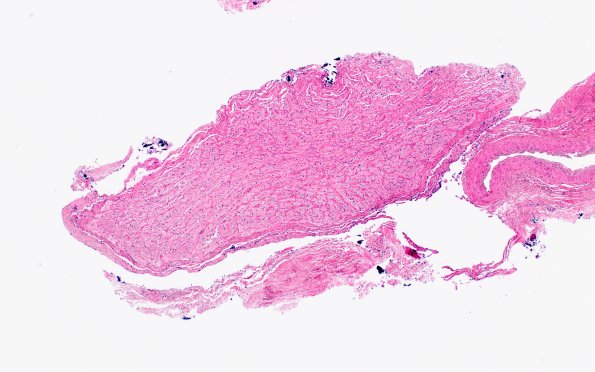 2D1Wolfram syndrome (Case 2) N15 H&E 4X 2
