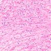 2D3 Wolfram syndrome (Case 2) N15 GFAP 4X 2