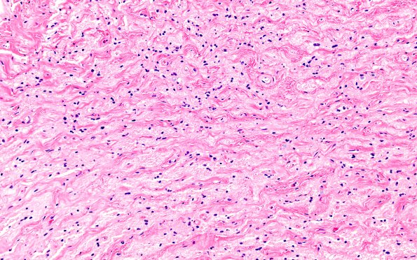 2D3 Wolfram syndrome (Case 2) N15 GFAP 4X 2