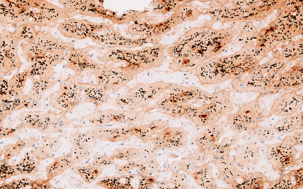 2D8 HWolfram syndrome (Case 2) N15 NF 20X 1
