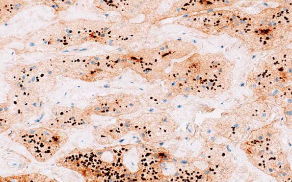 2D9 Wolfram syndrome (Case 2) N15 NF 40X 2
