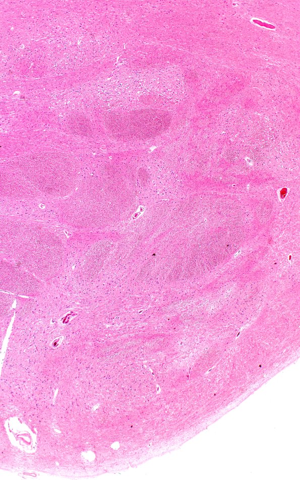 2F1A (Case 2) N7 H&E 2XA