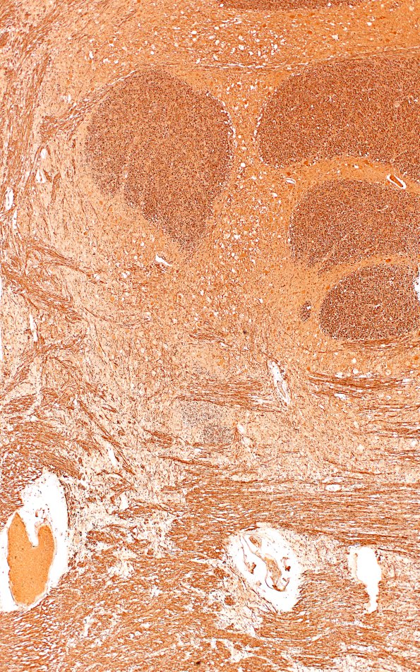 2F3A (Case 2) N7 NF4XAB